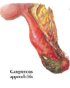  Gangrenous appendicitis 